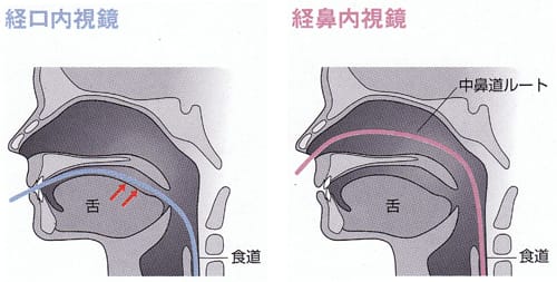 内視鏡説明画像